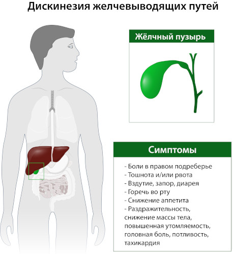 Холецистит бескаменный хронический. Cимптомы и лечение