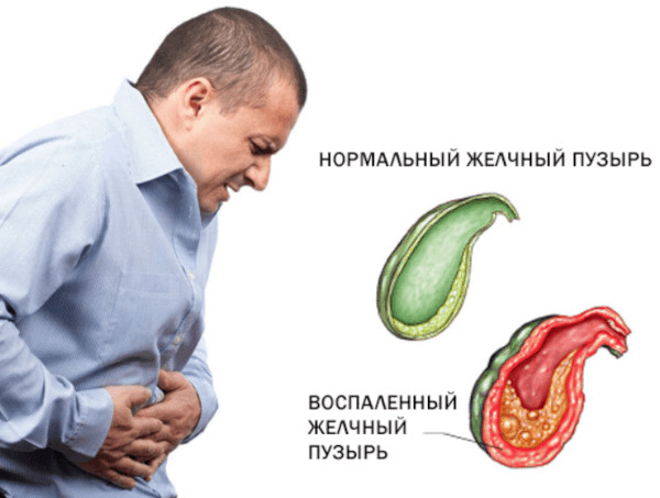 Холецистит бескаменный хронический. Cимптомы и лечение