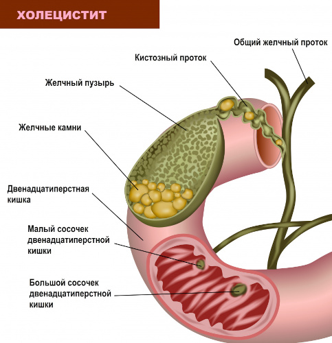 Холецистит калькулезный острый. Это что, лечение, клинические рекомендации