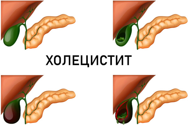 Холецистит калькулезный острый. Это что, лечение, клинические рекомендации