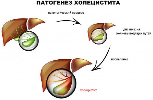 Холецистит калькулезный острый. Это что, лечение, клинические рекомендации