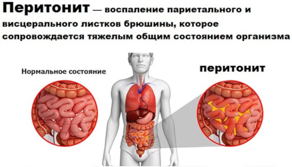 Холецистит калькулезный острый. Это что, лечение, клинические рекомендации