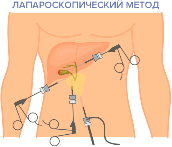 Некалькулезный холецистит. Что это такое, симптомы, лечение