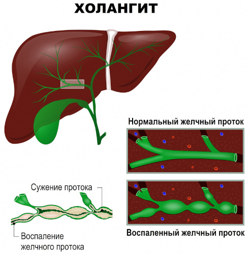 Некалькулезный холецистит. Что это такое, симптомы, лечение