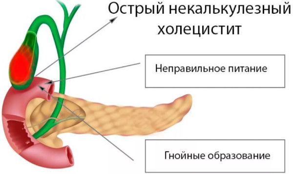 Некалькулезный холецистит. Что это такое, симптомы, лечение