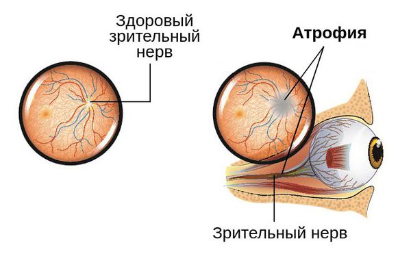 Игрель (Igrel) капли глазные. Инструкция по применению, цена, отзывы