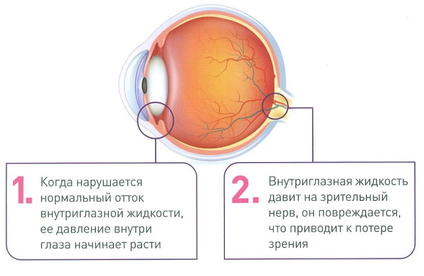 Игрель (Igrel) капли глазные. Инструкция по применению, цена, отзывы