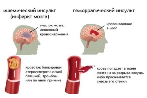 Инфаркт головного мозга и инсульт. Разница и отличия