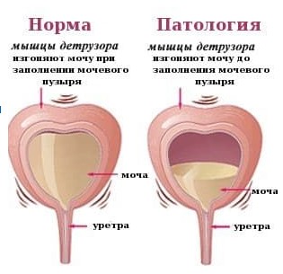 Аналоги Тамсулозин в таблетках дешевле. Цены