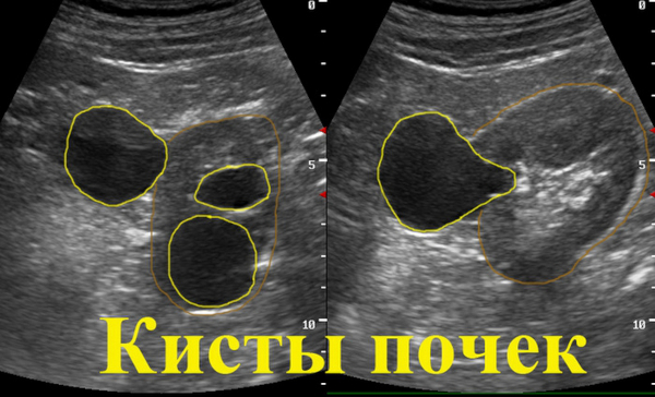 Киста почки. Что это такое, симптомы и лечение у взрослых