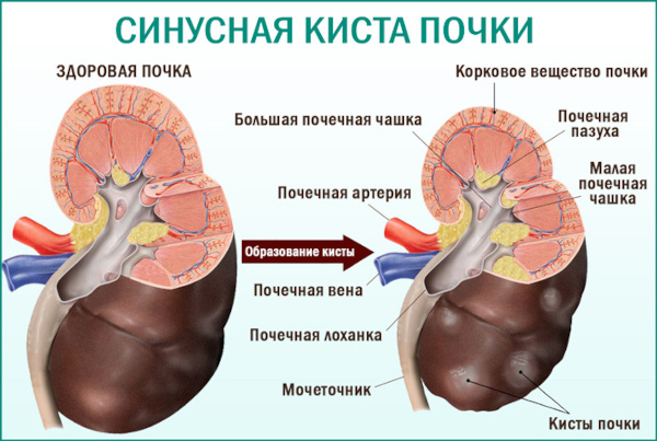 Киста почки. Что это такое, симптомы и лечение у взрослых