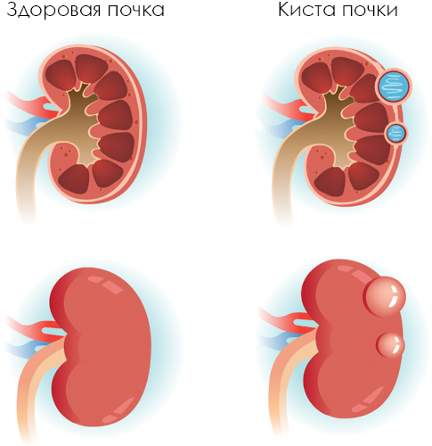 Киста почки. Что это такое, симптомы и лечение у взрослых