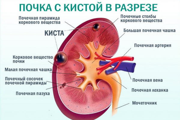 Киста почки. Что это такое, симптомы и лечение у взрослых