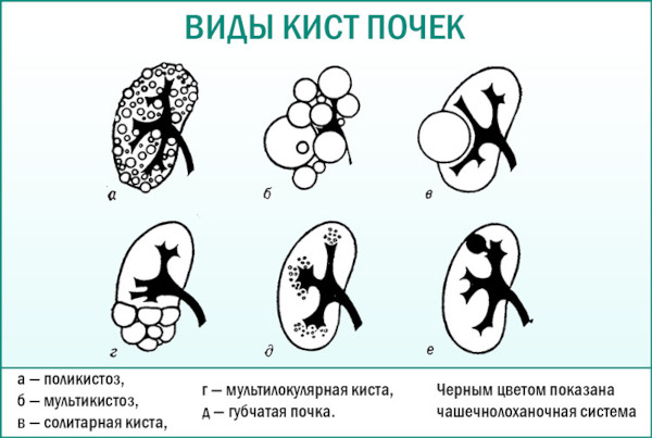 Киста почки. Что это такое, симптомы и лечение у взрослых