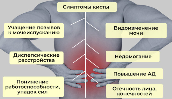 Киста почки. Что это такое, симптомы и лечение у взрослых