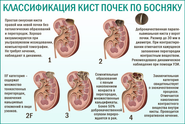 Киста почки. Что это такое, симптомы и лечение у взрослых