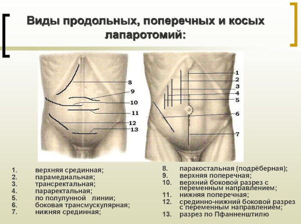 Лапаротомия. Это что такое, виды операции