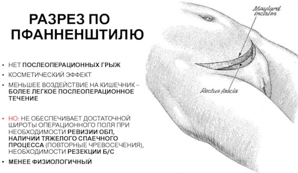 Лапаротомия. Это что такое, виды операции