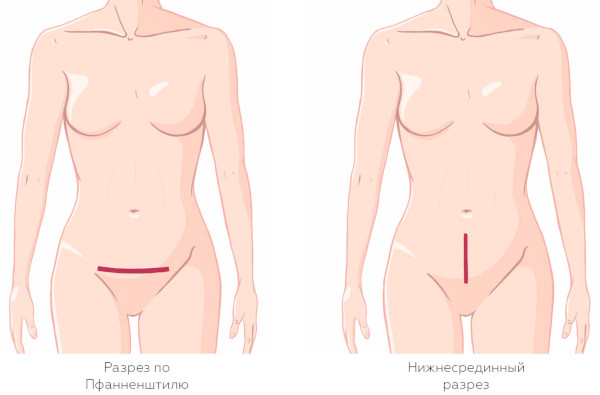 Лапаротомия. Это что такое, виды операции