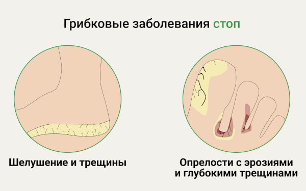 Лечение грибка стопы в домашних условиях