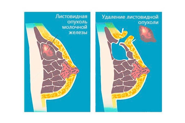 Листовидная фиброаденома молочной железы на УЗИ. Фото