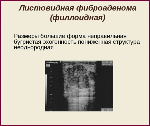 Листовидная фиброаденома молочной железы на УЗИ. Фото