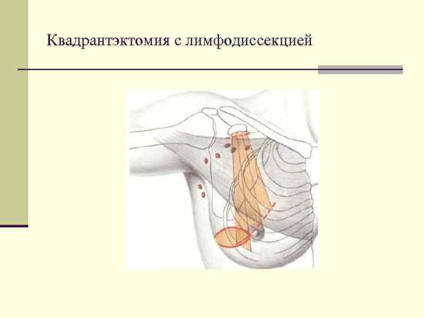 Листовидная фиброаденома молочной железы на УЗИ. Фото