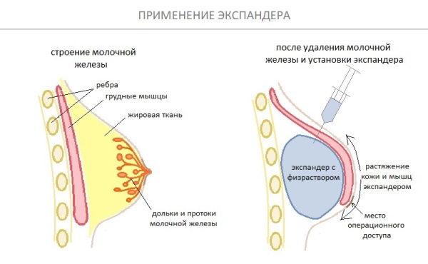 Листовидная фиброаденома молочной железы на УЗИ. Фото