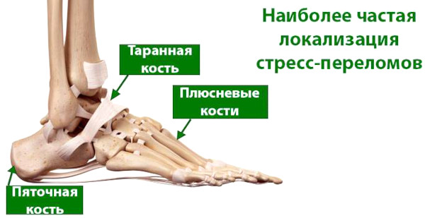 Стрессовый (маршевый) перелом стопы. Симптомы и лечение