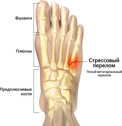 Стрессовый (маршевый) перелом стопы. Симптомы и лечение