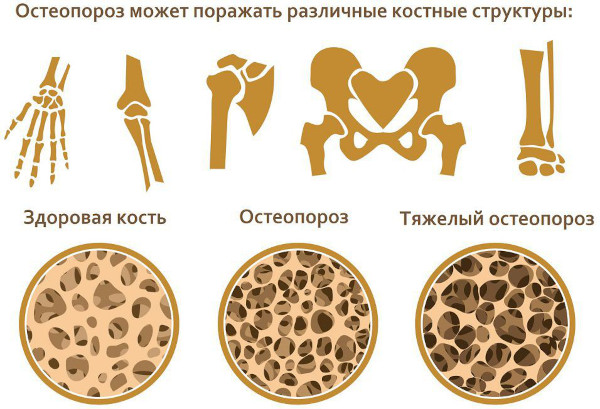 Стрессовый (маршевый) перелом стопы. Симптомы и лечение