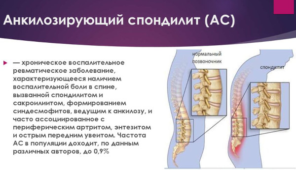 Невралгия в области сердца. Симптомы и лечение