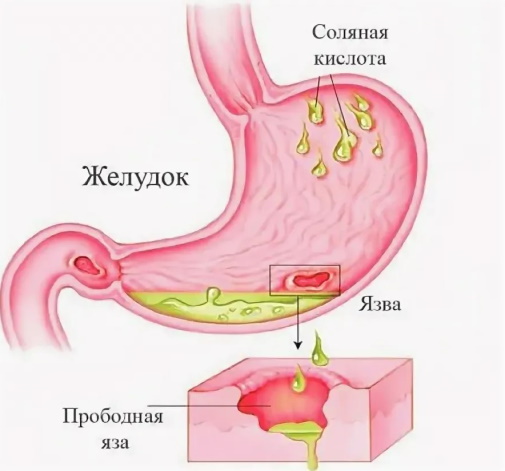 Осложнения язвенной болезни желудка и двенадцатиперстной кишки