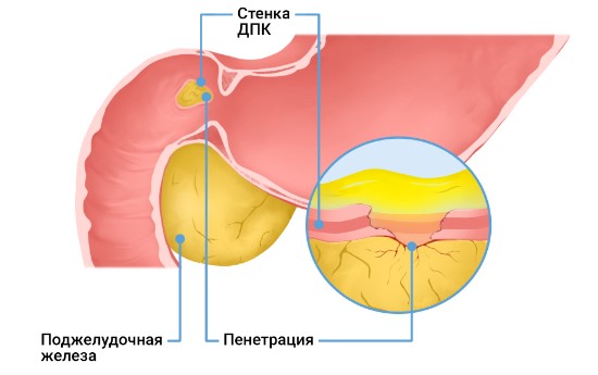 Осложнения язвенной болезни желудка и двенадцатиперстной кишки