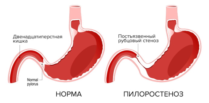 Осложнения язвенной болезни желудка и двенадцатиперстной кишки