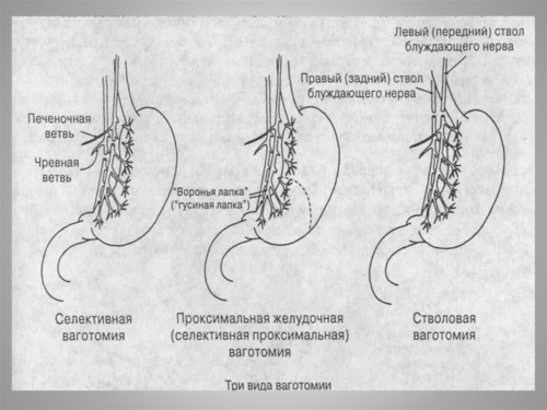 Осложнения язвенной болезни желудка и двенадцатиперстной кишки