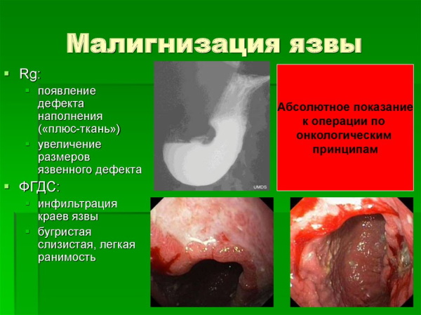 Осложнения язвенной болезни желудка и двенадцатиперстной кишки