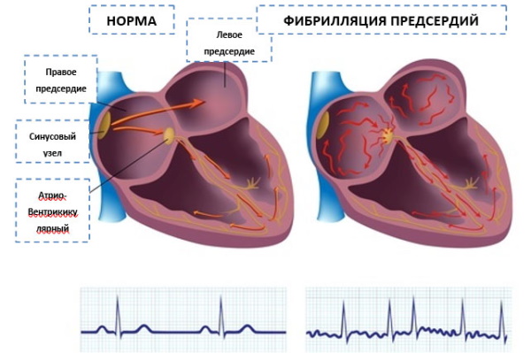 Пароксизмальная форма фибрилляции предсердий. Что это такое, лечение