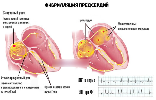 Пароксизмальная форма фибрилляции предсердий. Что это такое, лечение