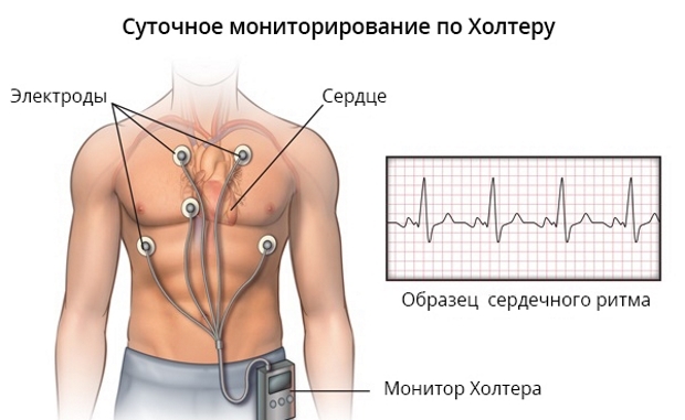 Миокардит у детей. Симптомы, лечение, диагностика