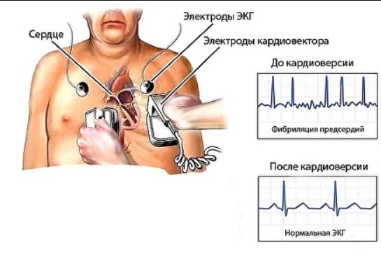 Пароксизмальная форма фибрилляции предсердий. Что это такое, лечение