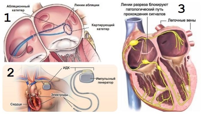 Пароксизмальная форма фибрилляции предсердий. Что это такое, лечение