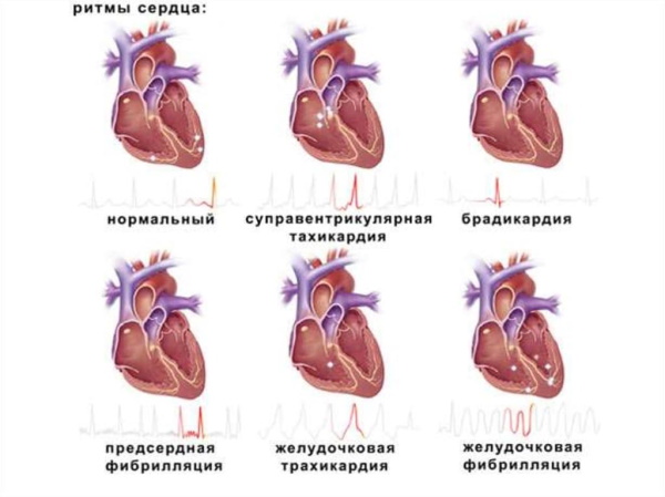 Пароксизмальная форма фибрилляции предсердий. Что это такое, лечение