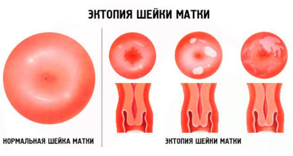 Псевдоэрозия шейки матки. Что это такое, симптомы, лечение