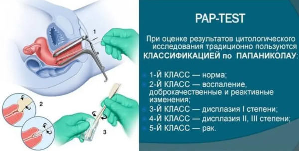 Псевдоэрозия шейки матки. Что это такое, симптомы, лечение