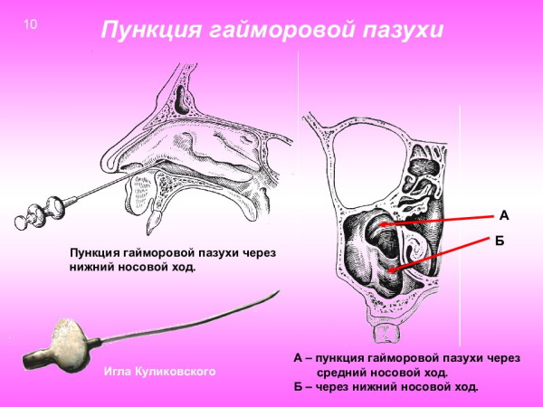 Пункция гайморовой верхнечелюстной пазухи. Что это, техника