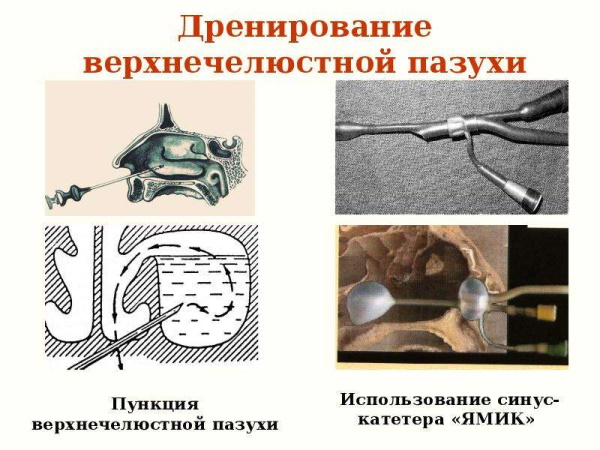 Пункция гайморовой верхнечелюстной пазухи. Что это, техника