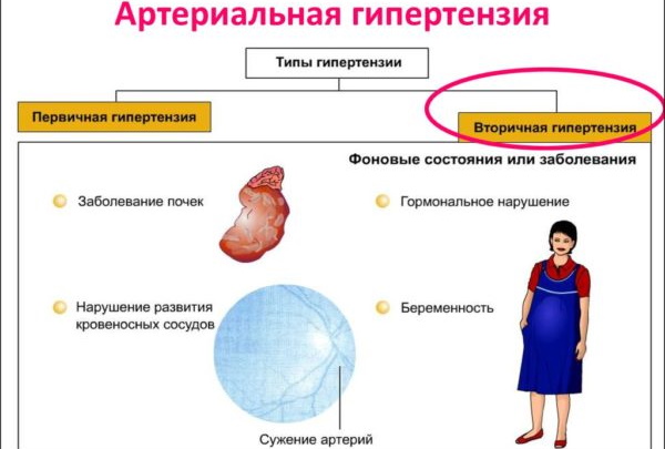 Симптоматическая артериальная гипертензия (вторичная). Что это такое