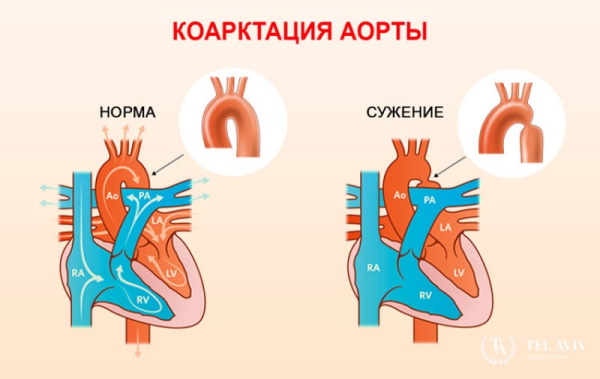 Симптоматическая артериальная гипертензия (вторичная). Что это такое