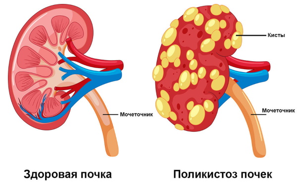 Симптоматическая артериальная гипертензия (вторичная). Что это такое